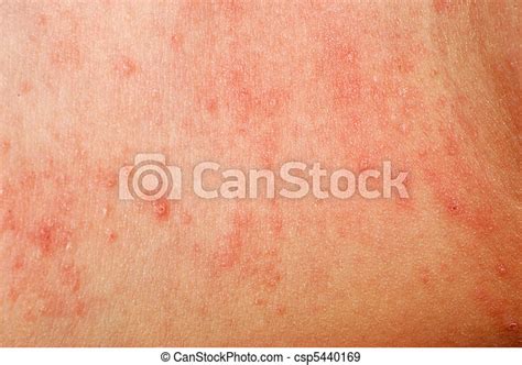 Stock Photographs Of Allergic Rash Dermatitis Skin Texture Of Patient