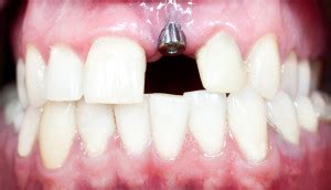 We did not find results for: How Long Does It Take For Dental Implants To Heal?