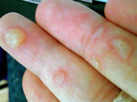 Blisters On Hands Treatment Pictures Causes Remedies