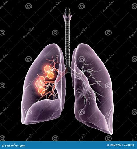 Lung Cancer Or Bronchial Carcinoma 3d Medically Illustration On Black