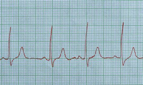 Sinus Rhythm What S Normal And Not