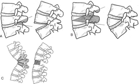 Schematic Diagram Of The Three Osteotomies Showing The Open I