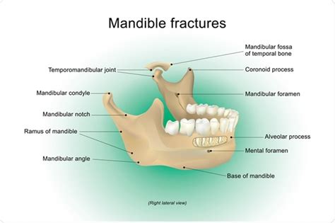 What Are Mandibular Fractures