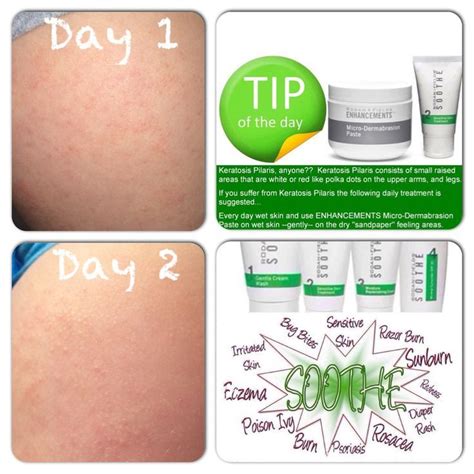 17 Best Images About Solution For Treating Keratosis Pilaris Aka