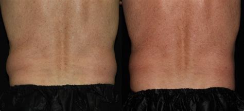 Love Handles Flanks Coolsculpting Before And After Cost Reviews