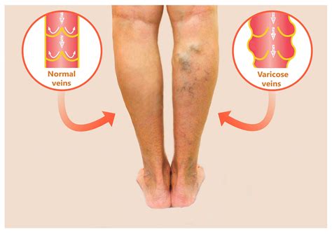 Home Treatments For Varicose Veins The Vein Company