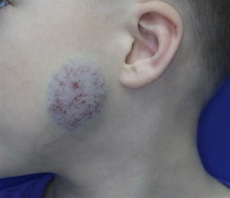 Lump On Back Of Childs Neck