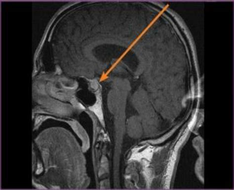 Pre Surgery The First Mri T1 Weighted Sagittal The Pituitary