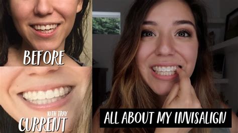All About My Invisalign Before And After Pics Cost Experience So Far