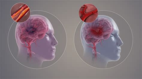 Symptoms Of Brain Haemorrhage General Center