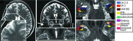 Ultra High Field Mr Neuroimaging American Journal Of Neuroradiology