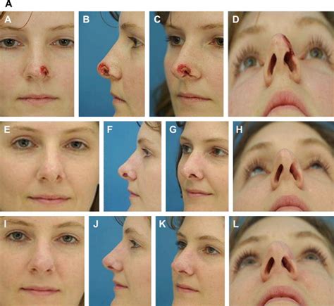 Cartilage Grafting In Nasal Reconstruction Plastic Surgery Key