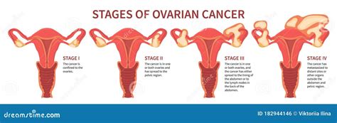 Four Stages Of Ovarian Cancer Isolated White Stock Vector