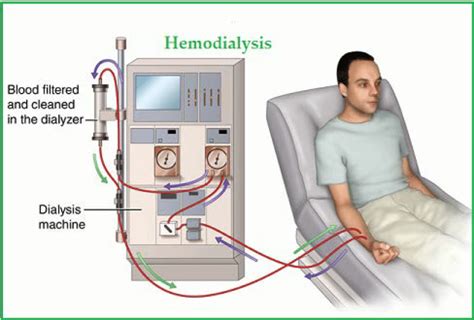 Treating Chronic Kidney Disease With Dialysis Premier Surgical