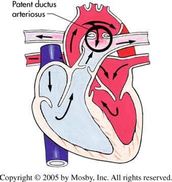 A soft murmur is an online background noise generator designed to help you relax, focus, and tune out unpleasant sounds from your environment. Flashcards - heart - fetal circulation change acyanotic ...