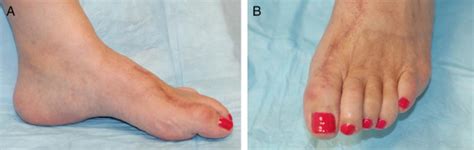 A Practical Correction Of Great Toe Claw Deformity The Journal Of