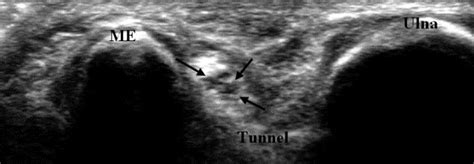 Ultrasound In The Diagnosis Of Ulnar Neuropathy At The Cubital Tunnel