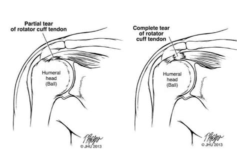 The Complete Guide To A Rotator Cuff Tear Kinetic Labs Toronto