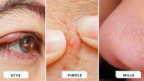 Eyelid Bumps 101 How To Identify Styes Milia And Pimples Allure