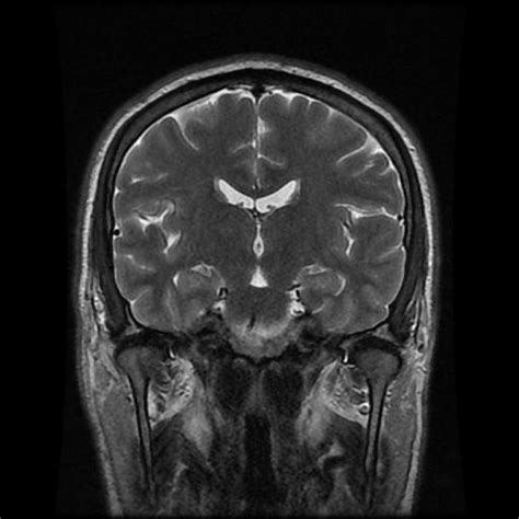 Thalamic Lacunar Infarct Image Radiopaedia Org