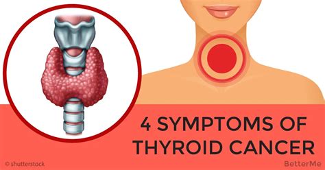 Besides the presence of a thyroid nodule, other potential symptoms of thyroid cancer (although these are not common) include: Cancer of the thyroid is very dangerous, because nobody ...