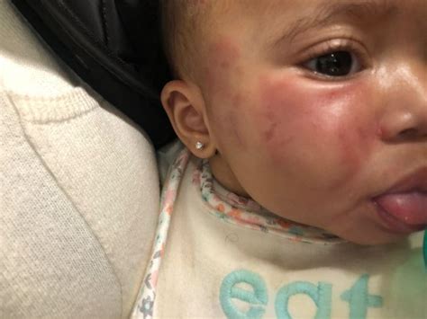 Infant Leaves New Jersey Daycare Covered In Bruises