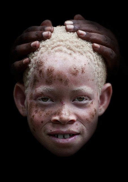 Tanzanian Albino Girl Albino Girl Albinism Albino