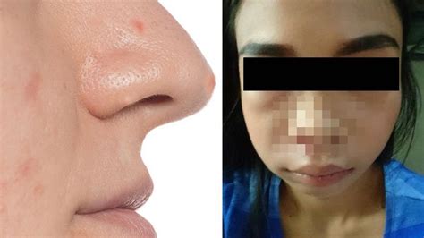 Jerawat Di Lubang Hidung Tak Sengaja Pecah Wajah Gadis Ini Bengkak Seperti Gondok Simak
