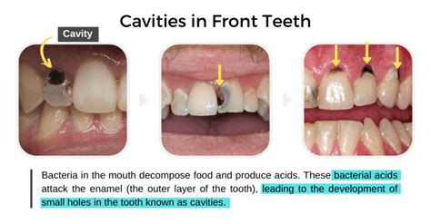 How To Treat A Cavity On Front Tooth Chong Scarbrough