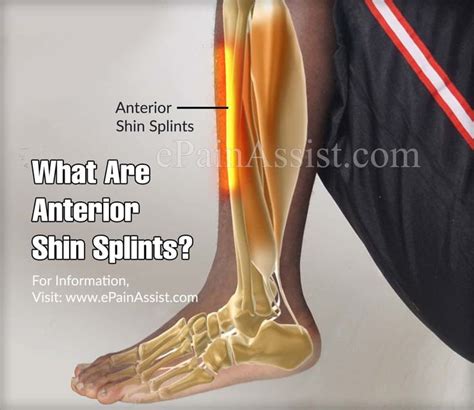 Pin On Sports And Shin Splints
