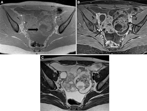 Mri Appearance Of Mucinous Cystadenocarcinoma Of The Ovary A Axial