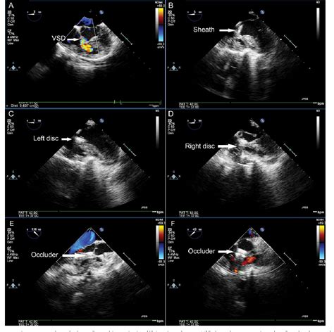 Figure 3 From Results Of Comparing Transthoracic Device Closure And