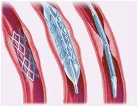 Что такое стентирование сосудов сердца? :: SYL.ru Картинка - Что такое стентирование сосудов сердца? :: SYL.ru