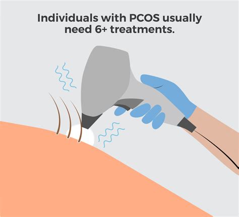 Laser Hair Removal And Pcos What You Need To Know Livsmooth