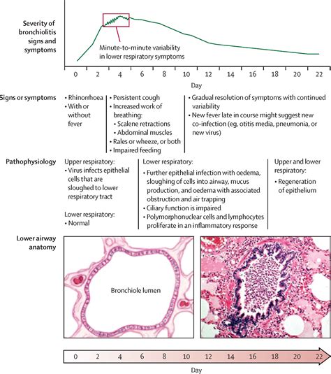 Viral Bronchiolitis The Lancet