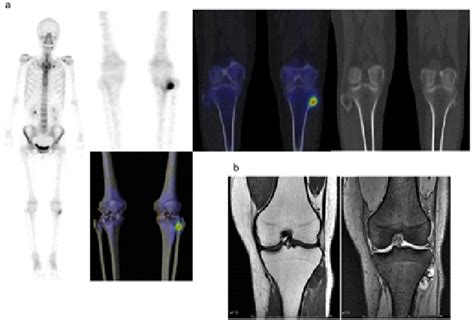 Figure 2 From Quantitative Bone Spectct Applications For Cartilaginous