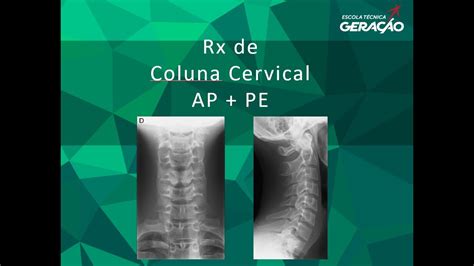 Radiografia Da Coluna Cervical Ap Pe Youtube