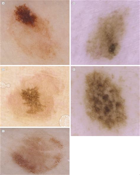 The Significance Of Eccentric And Central Hyperpigmentation Multifocal