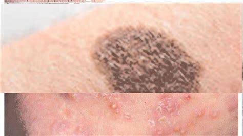 Some of the more common or noticeable skin diseases include common skin diseases - YouTube