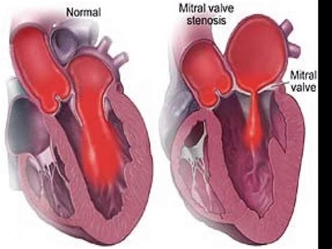 Valvular Heart Diseaseppt Ppt Powerpoint