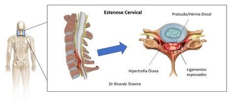 Estenose Cervical Uterina Sintomas