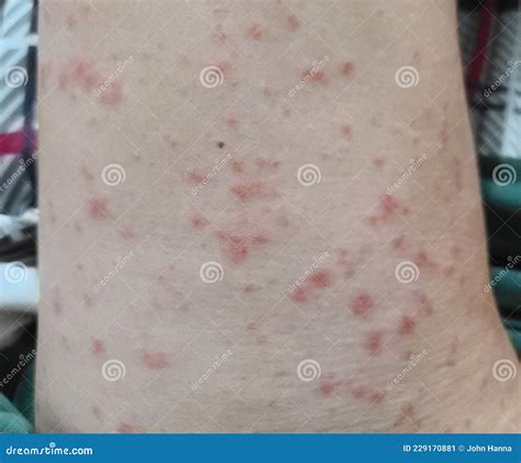 Bumpy Red Skin Rash Stock Image Image Of Skin Bumps 229170881