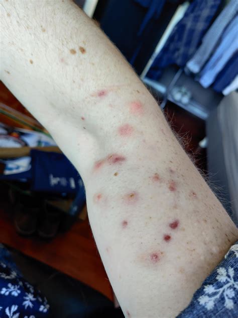 Painful Acne Cysts On Arm What To Do I Also Have Acne On My Back