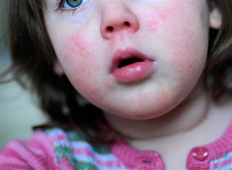 Baby Rashes Types Symptoms And More 2022