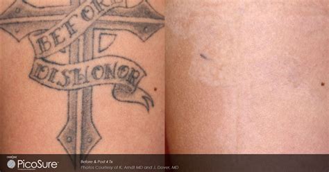 Laser Tattoo Removal Before And After Southeastern Dermatology