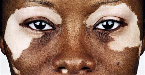 Vitiligo Skin Disease Causes Symptoms And Treatments Premier Clinic