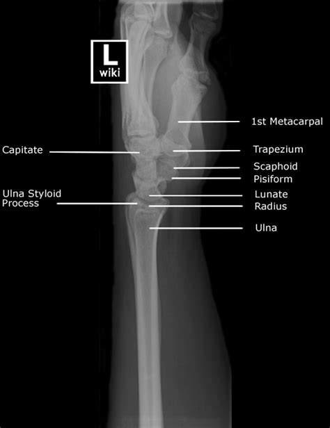 Wrist Radiographic Anatomy Wikiradiography