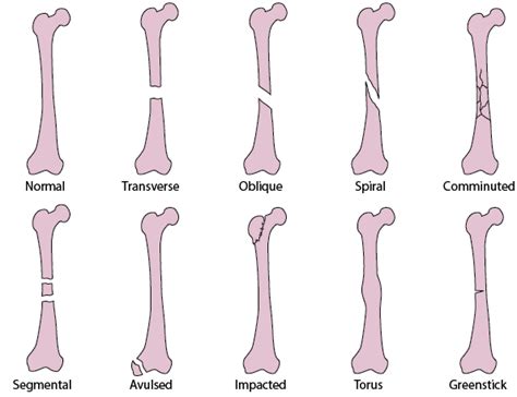 Figure Common Types Of Fracture Lines Msd Manual Professional Edition