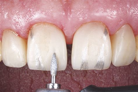 Facetas De Resina Direta Associadas Com Clareamento Dental Na Prática