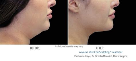 Coolsculpting Chin And Neck Fat Eliminate Double Chins And Turkey Necks